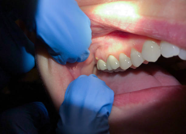 Best Emergency Treatment for Toothache in Lewiston, MN